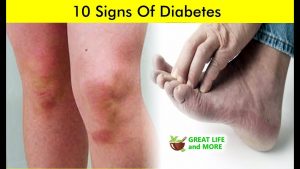 Read more about the article 10 Signs Of Diabetes  ?