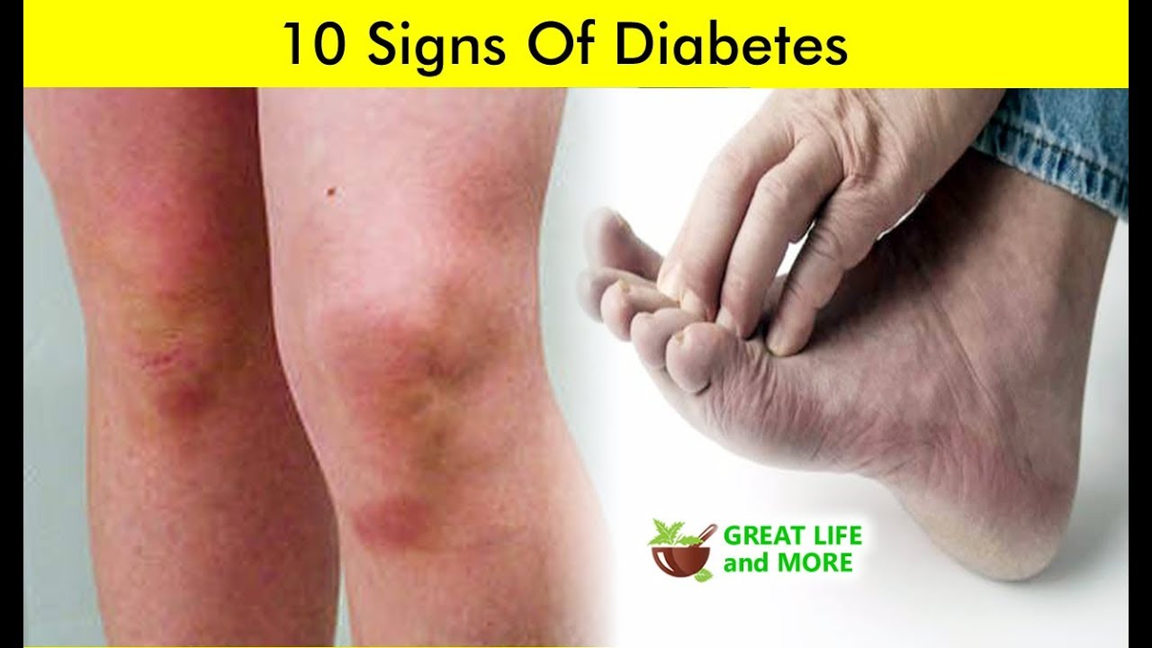 You are currently viewing 10 Signs Of Diabetes  ?