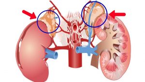 Read more about the article 2 Main Causes Of Kidney Disease You Must Know