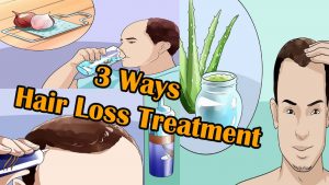 Read more about the article 3 Ways to Hair Loss Treatment For Men I Male Pattern Hair Loss