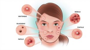 Read more about the article 6 Different Types Of Pimples That You Should Know
