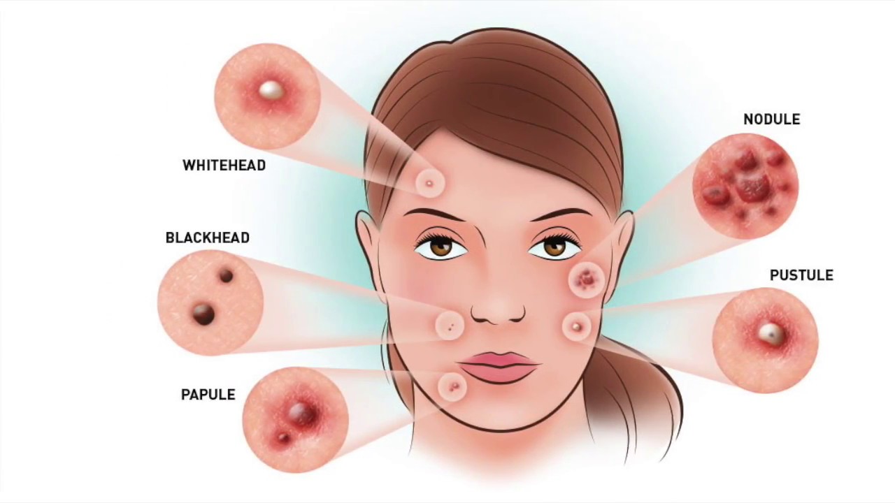 You are currently viewing 6 Different Types Of Pimples That You Should Know