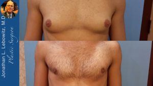 Read more about the article 6 Months Post-Op❗Gynecomastia Gland ?Removal At The Long Island Gynecomastia Center By Dr. Lebowitz