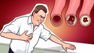 Read more about the article 7 Lifestyle Changes That Will Clean Your Arteries Naturally And Protect You From Heart Attack