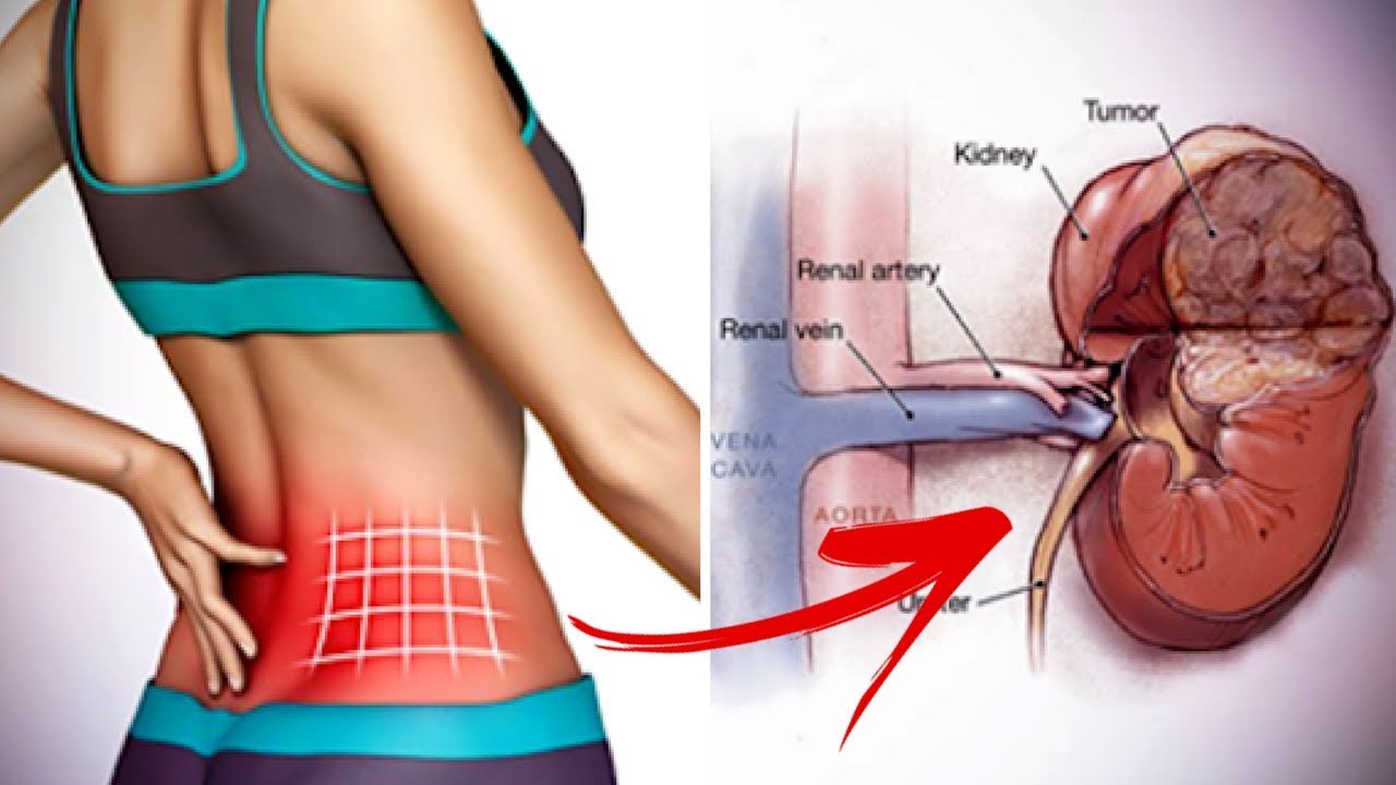 You are currently viewing 9 Signs & Symptoms Of Kidney Failure | 90% Peoples Are Not Aware