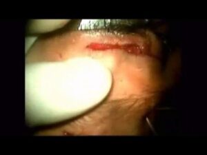 Opthalmogical/Eye Surgeries Video – 5