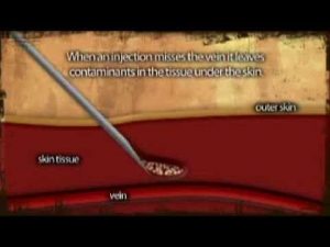 AIVL Vein Care Guide Abscess Formation Animation