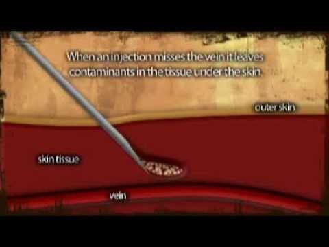 You are currently viewing AIVL Vein Care Guide Abscess Formation Animation