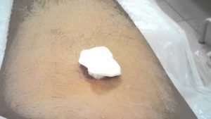 Read more about the article Abscess