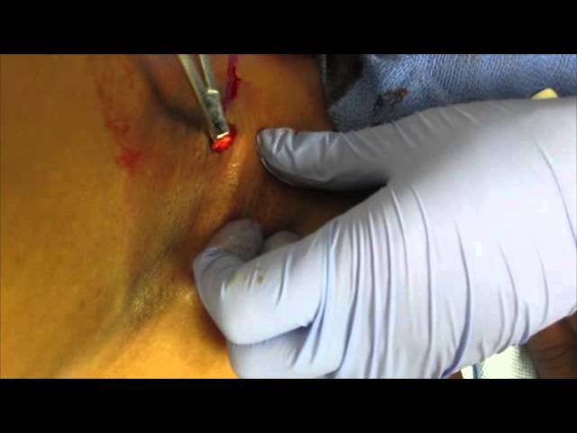 You are currently viewing Abscess Basics: Part 2a