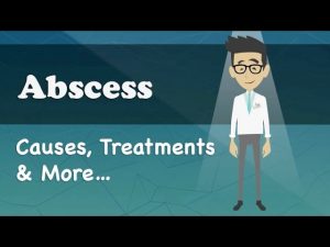 Read more about the article Abscess – Causes, Treatments & More…