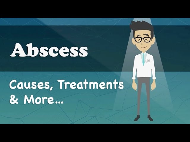 You are currently viewing Abscess – Causes, Treatments & More…