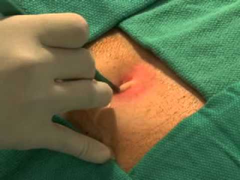 You are currently viewing Abscess Incision and Drainage