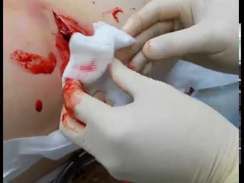 You are currently viewing Abscess​  Treatment
