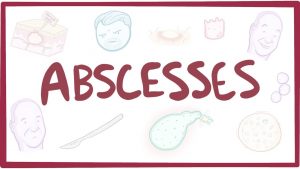 Abscesses – causes, symptoms, diagnosis, treatment, pathology