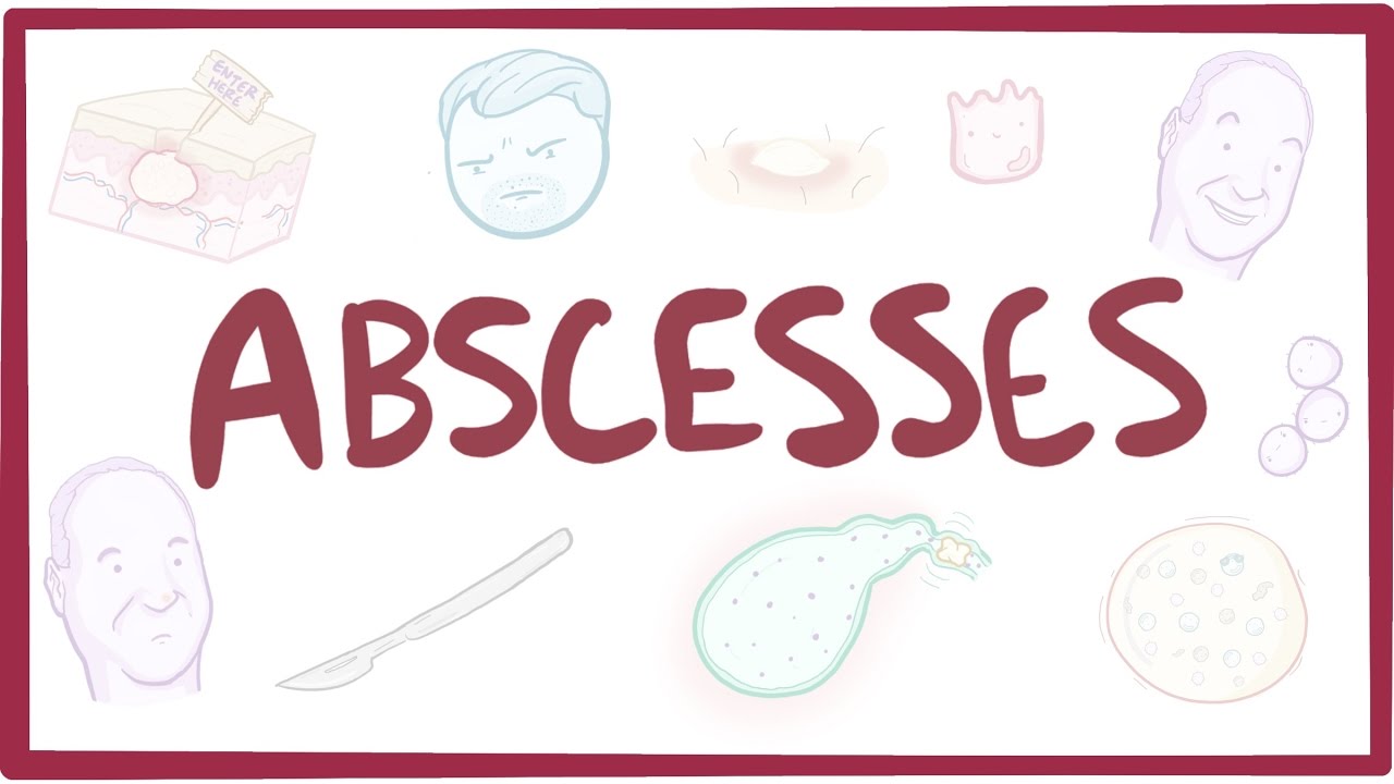 You are currently viewing Abscesses – causes, symptoms, diagnosis, treatment, pathology