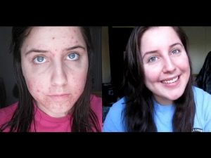Read more about the article Accutane Journey: 27 Weeks in 3 Minutes!