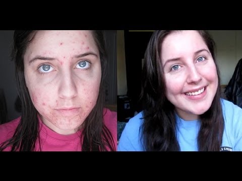 You are currently viewing Accutane Journey: 27 Weeks in 3 Minutes!