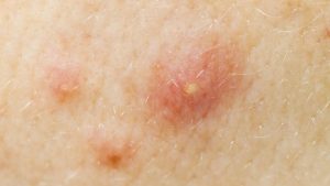 Read more about the article Acne Treatment – Accutane (Isotretinoin)