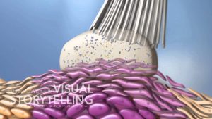 Read more about the article Actinic Keratosis Mode of Action Animation