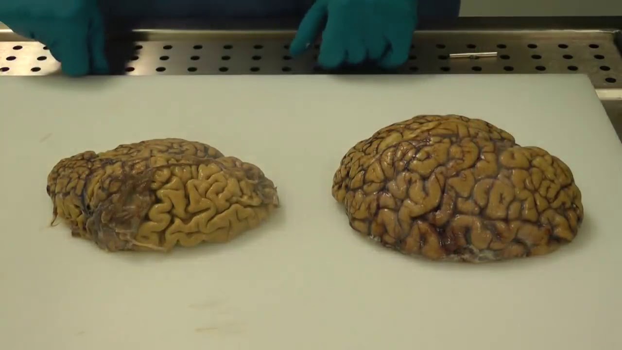 You are currently viewing Alzheimer’s brain Vs  Normal Brain!