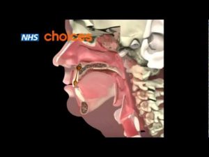 Read more about the article An animation about dental abscess.FLV