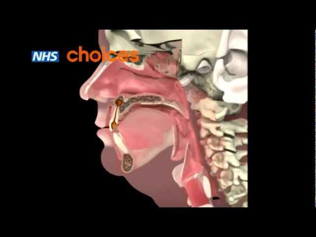 You are currently viewing An animation about dental abscess.FLV