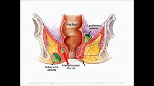 Read more about the article Anal Abscess – English