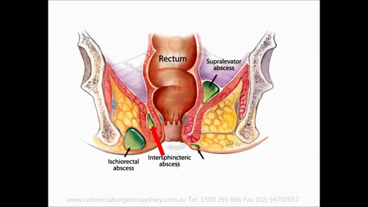 You are currently viewing Anal Abscess – English