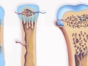 Anatomy and Physiology – Development of Bone
