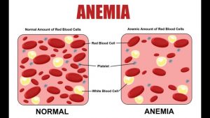 Read more about the article Anemia symptoms, causes and its treatment explained