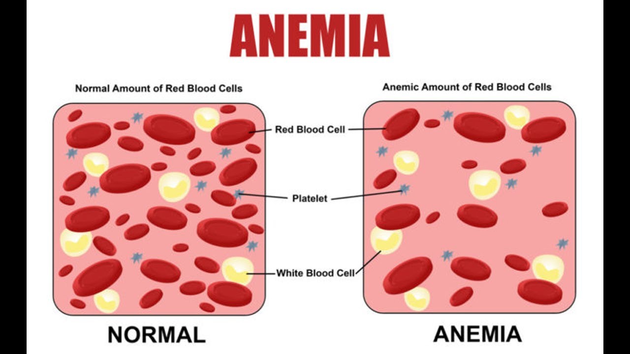 You are currently viewing Anemia symptoms, causes and its treatment explained
