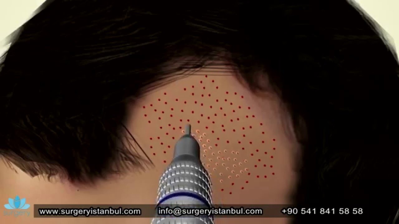 You are currently viewing Animation Hair Transplant – Surgery Istanbul Cosmetic