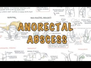 Read more about the article Anorectal Abscess (General Surgery) – Overview