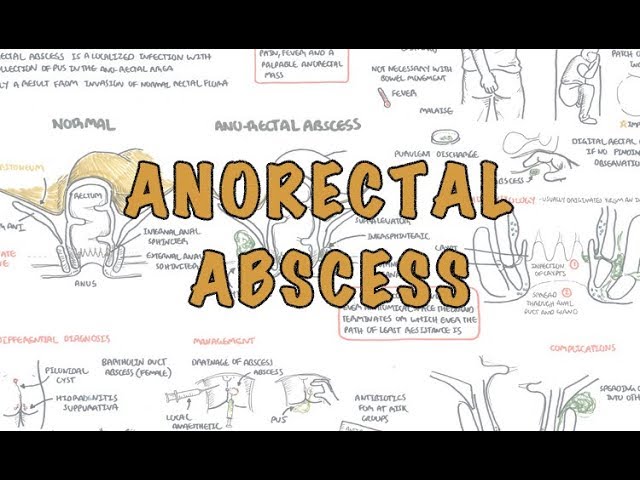 You are currently viewing Anorectal Abscess (General Surgery) – Overview