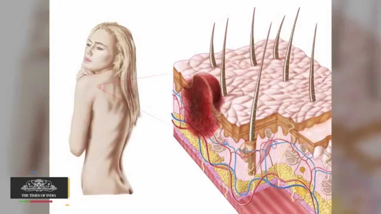 You are currently viewing Are You Suffering From Back Acne?
