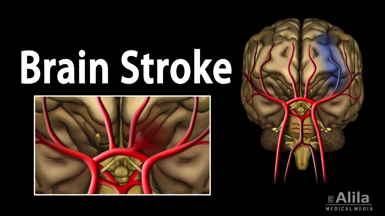 You are currently viewing Brain Stroke, Types of, Causes, Pathology, Symptoms, Treatment and Prevention, Animation.
