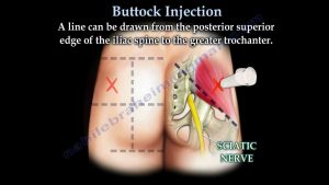 Buttock Injection – Everything You Need To Know – Dr. Nabil Ebraheim