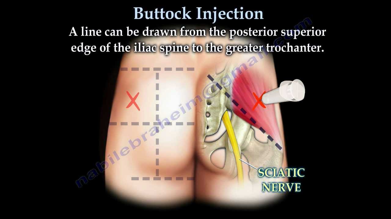 You are currently viewing Buttock Injection – Everything You Need To Know – Dr. Nabil Ebraheim