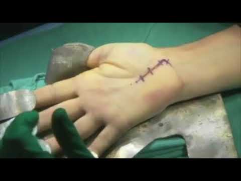 You are currently viewing Surgery Video – 2