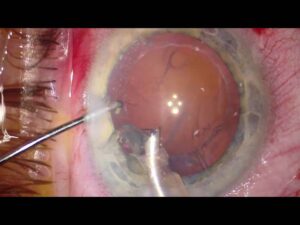 Opthalmogical/Eye Surgeries Video – 4