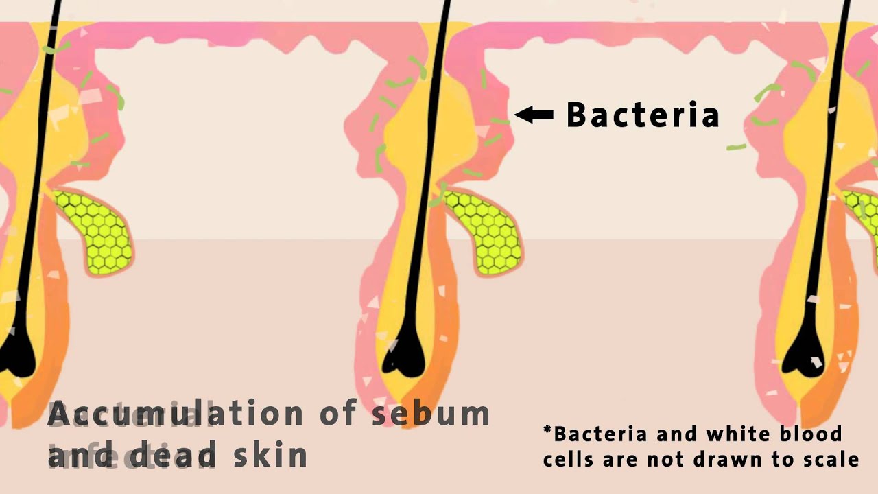 You are currently viewing ChemMatters: The Chemistry of Acne