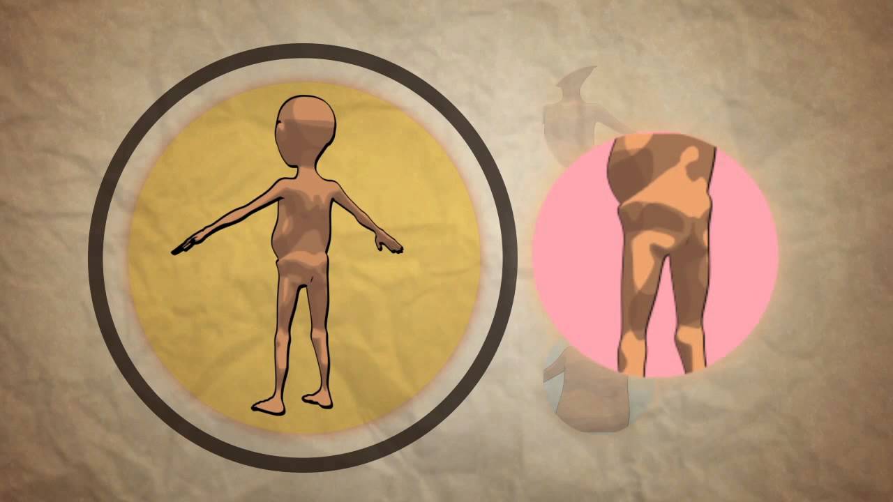 You are currently viewing Pediatric Malnutrition Video – 2