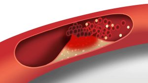 Cholesterol animation | Heart disease risk factors