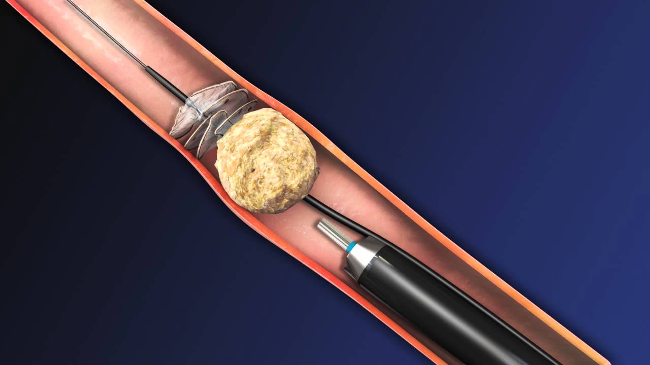 You are currently viewing CoAx 10mm Stone Control Catheter from Accordion Medical