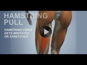 Common Sports Injuries: Hamstring Pull