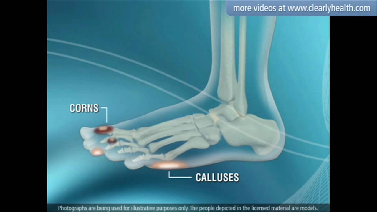 You are currently viewing Diabetes: Foot care