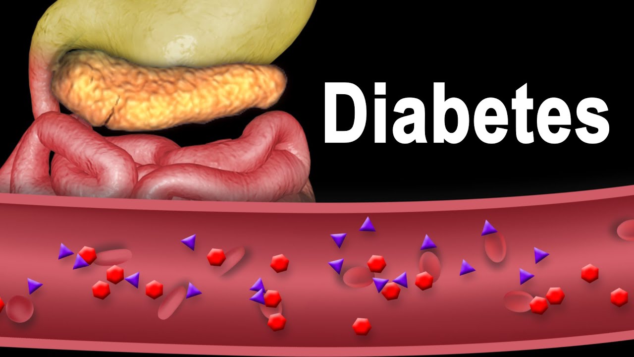 You are currently viewing Diabetes Type 1 and Type 2, Animation.