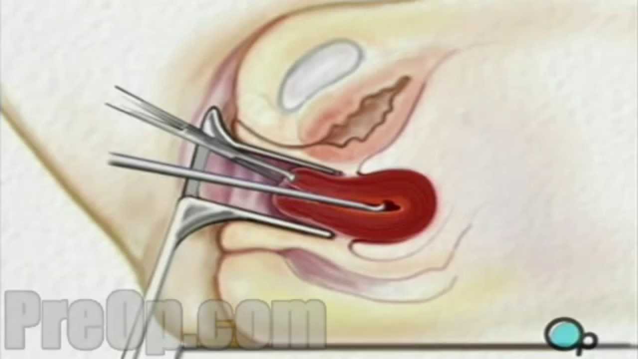 You are currently viewing Obstrics Surgeries Video – 4