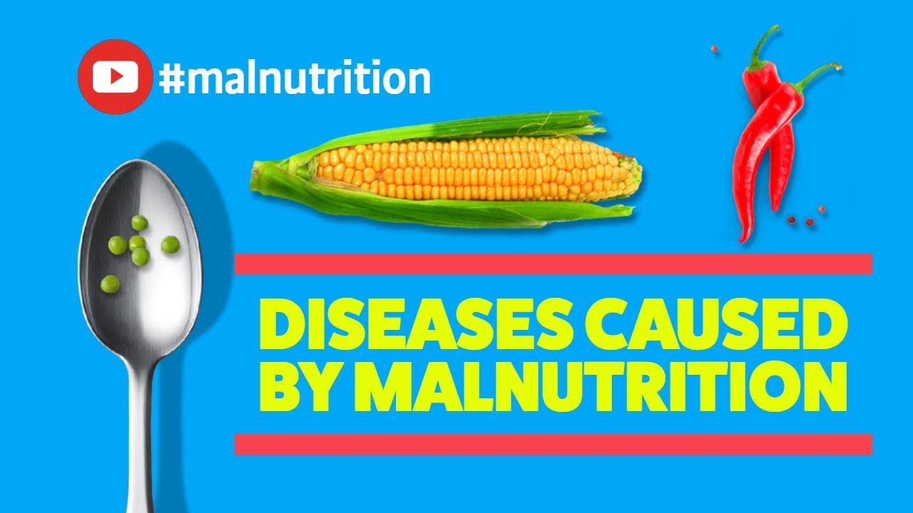 You are currently viewing Diseases Caused by Malnutrition – SCURVY, RICKETS, BERIBERI, PELLAGRA